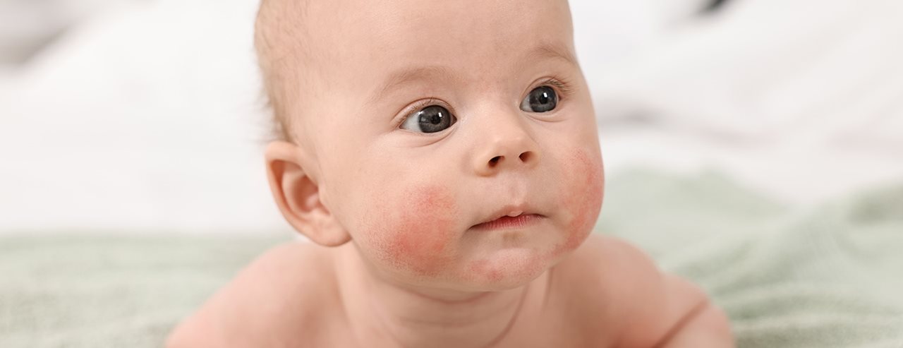 Neurodermatitis, pelenkakiütés és társaik: egy gyerekbőrgyógyász elmagyarázza, mi áll a gyakori bőrproblémák mögött