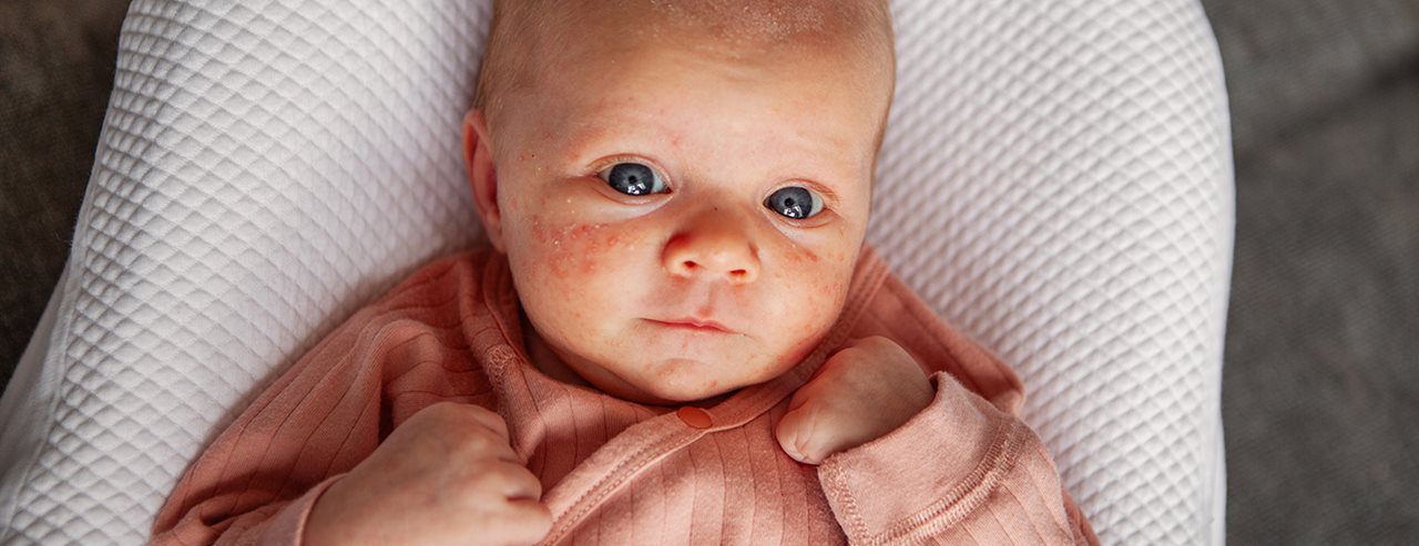 Pattanások a baba bőrén: ezt tehetjük akné ellen a gyermekbőrgyógyász szerint