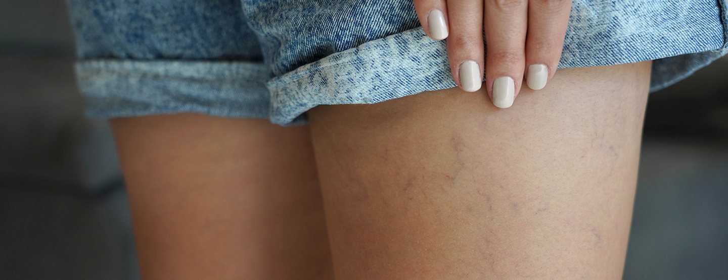 Seprűvénák eltávolítása: egy bőrgyógyász elárulja, hogyan lehetséges