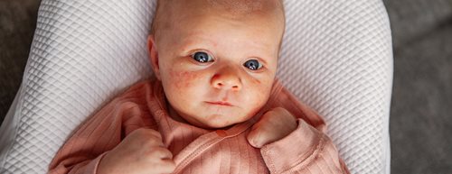 Pattanások a baba bőrén: ezt tehetjük akné ellen a gyermekbőrgyógyász szerint