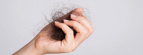 Foltos hajhullás: mi okozza, és hogyan gyógyítható?