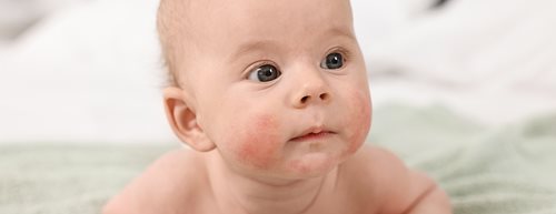 Neurodermatitis, pelenkakiütés és társaik: egy gyerekbőrgyógyász elmagyarázza, mi áll a gyakori bőrproblémák mögött