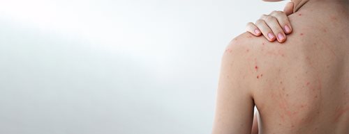 Pattanások a háton: ezt tanácsolja a bőrgyógyász, ha tényleg meg akarsz szabadulni a bacne-tól
